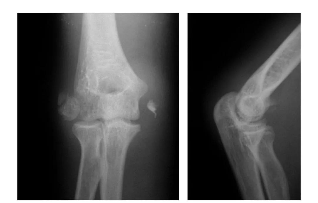 青少年肘部损伤最常见的是,肘部桡神经损伤的临床表现