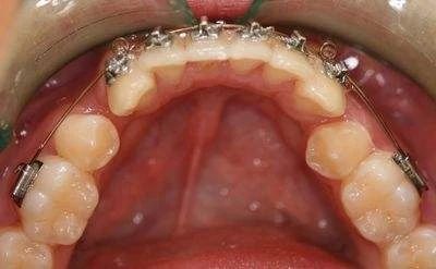 南宁牙齿矫正的每一个详细步骤,儿童的牙齿矫正的步骤