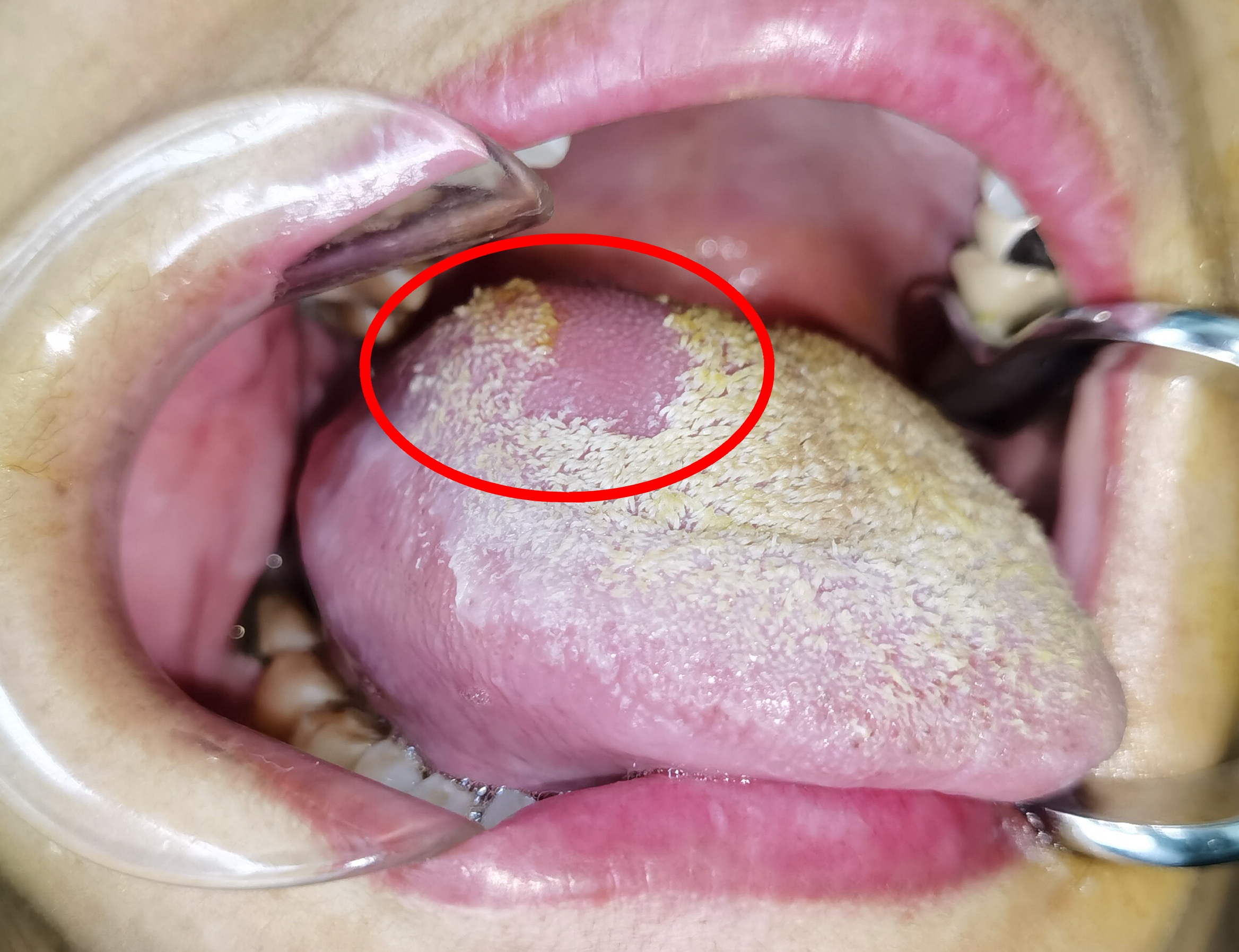 鱼刺在舌头上容易成舌癌吗,鱼刺扎进喉咙肉里10多年