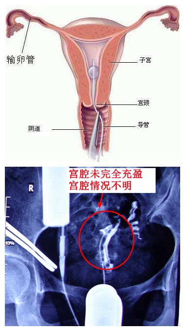 输卵管通畅度医生误诊后果严重，反复宫外孕责任在谁？