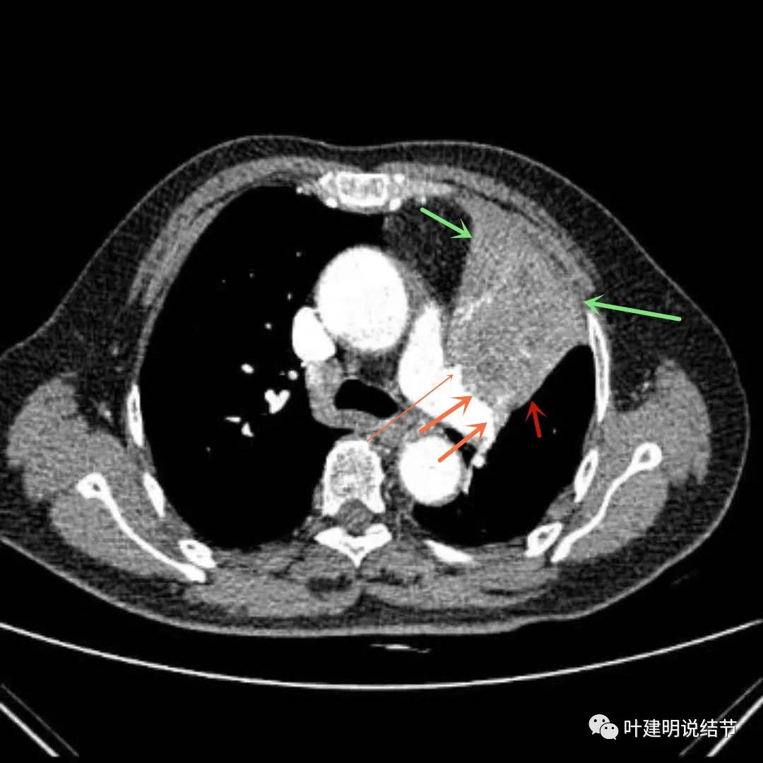 高龄肺癌靶向治疗效果,高龄老人肺癌早期适合放疗吗