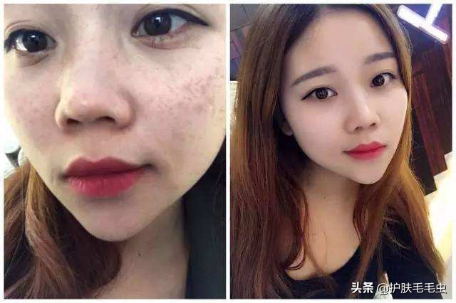 脸颊两边长斑最有效的淡化妙招,脸颊两侧长斑几年了怎么去除