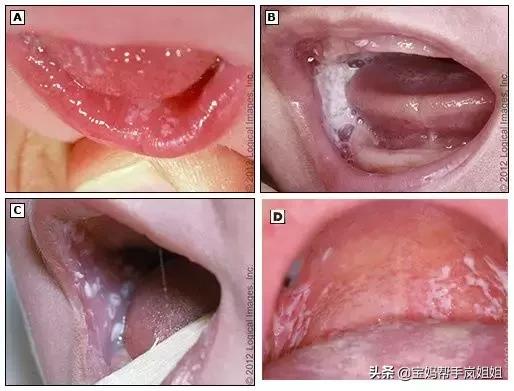 鹅口疮常见的感染菌是什么,引起鹅口疮最常见的因素有