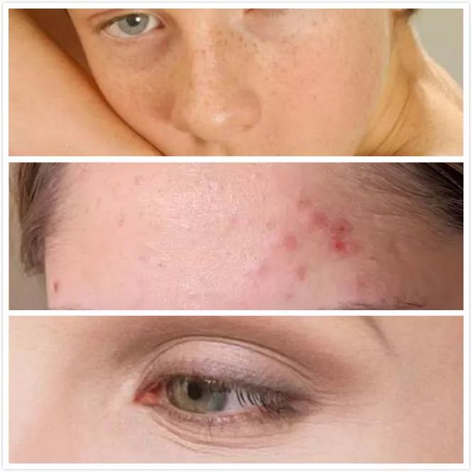 有效祛痘印的痘痘贴,祛痘痘的药膏明星