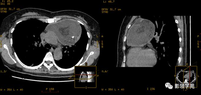 纵隔和肾上腺恶性肿瘤,纵隔性肿瘤位置图