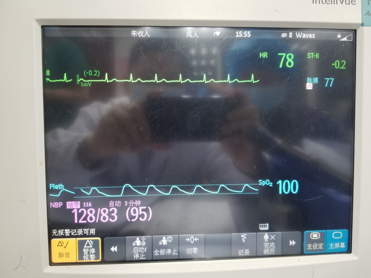 永久性房颤做射频消融成功案例,全国首例脉冲电场消融房颤