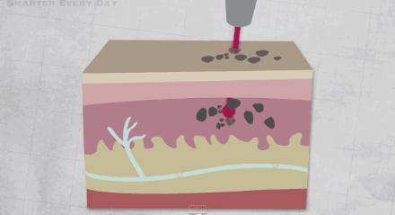 激光洗纹身出血吗,洗纹身是什么体验