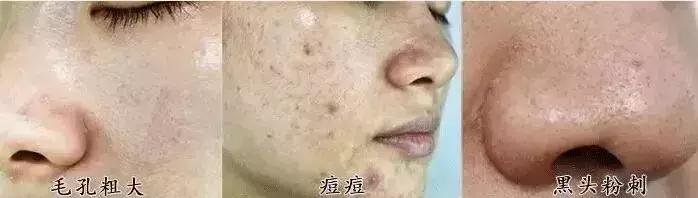 痘痘挤出的白米粒,痘痘挤出白点和血算干净了吗