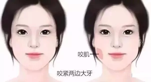 溶脂针和瘦脸针不一样吗,想让脸瘦是打溶脂针还是瘦脸针呢