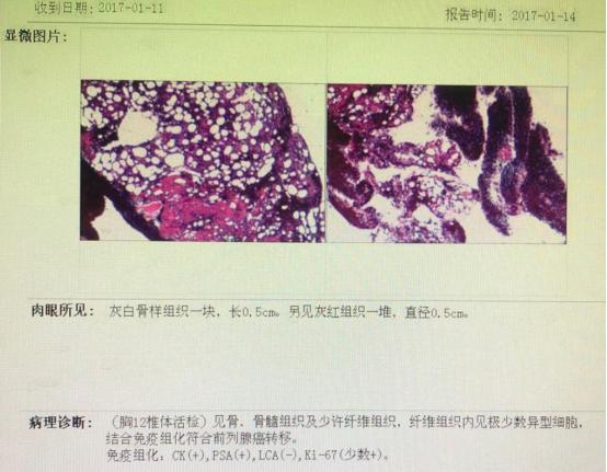 前列腺癌转移骨髓瘤治愈经验,前列腺癌骨转移抗癌成功案例