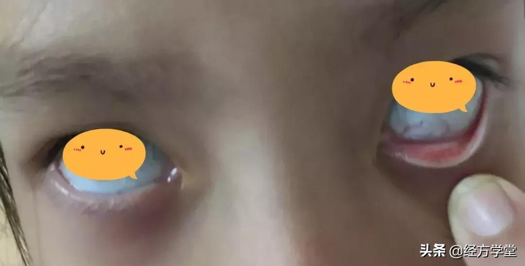 小儿感冒久治不好,小儿感冒反复发烧怎么办