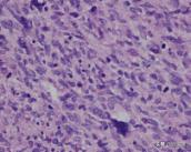 菁讲:你所不知道的横纹肌肉瘤