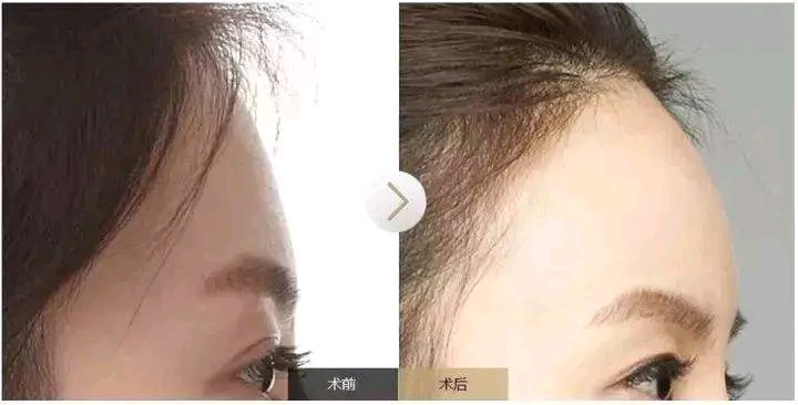 打玻尿酸可以让人变漂亮吗,打玻尿酸真的能减肥吗