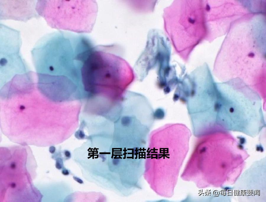 打过宫颈癌针需要查有没有抗体吗,35-45岁打宫颈癌疫苗最适合打几价