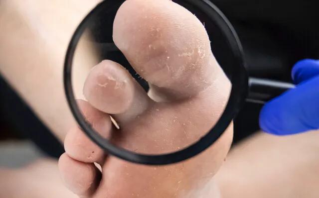 脚气足癣怎么治疗,脚气足癣能治愈吗