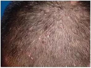 头皮穿凿性毛囊炎如何根治,头皮毛囊炎可以根治吗该如何治疗