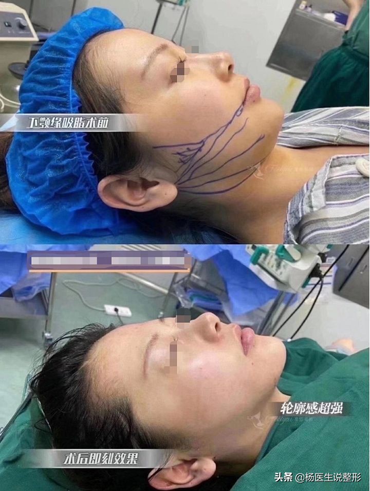 吸脂手术有哪几种类型,吸脂手术很微创