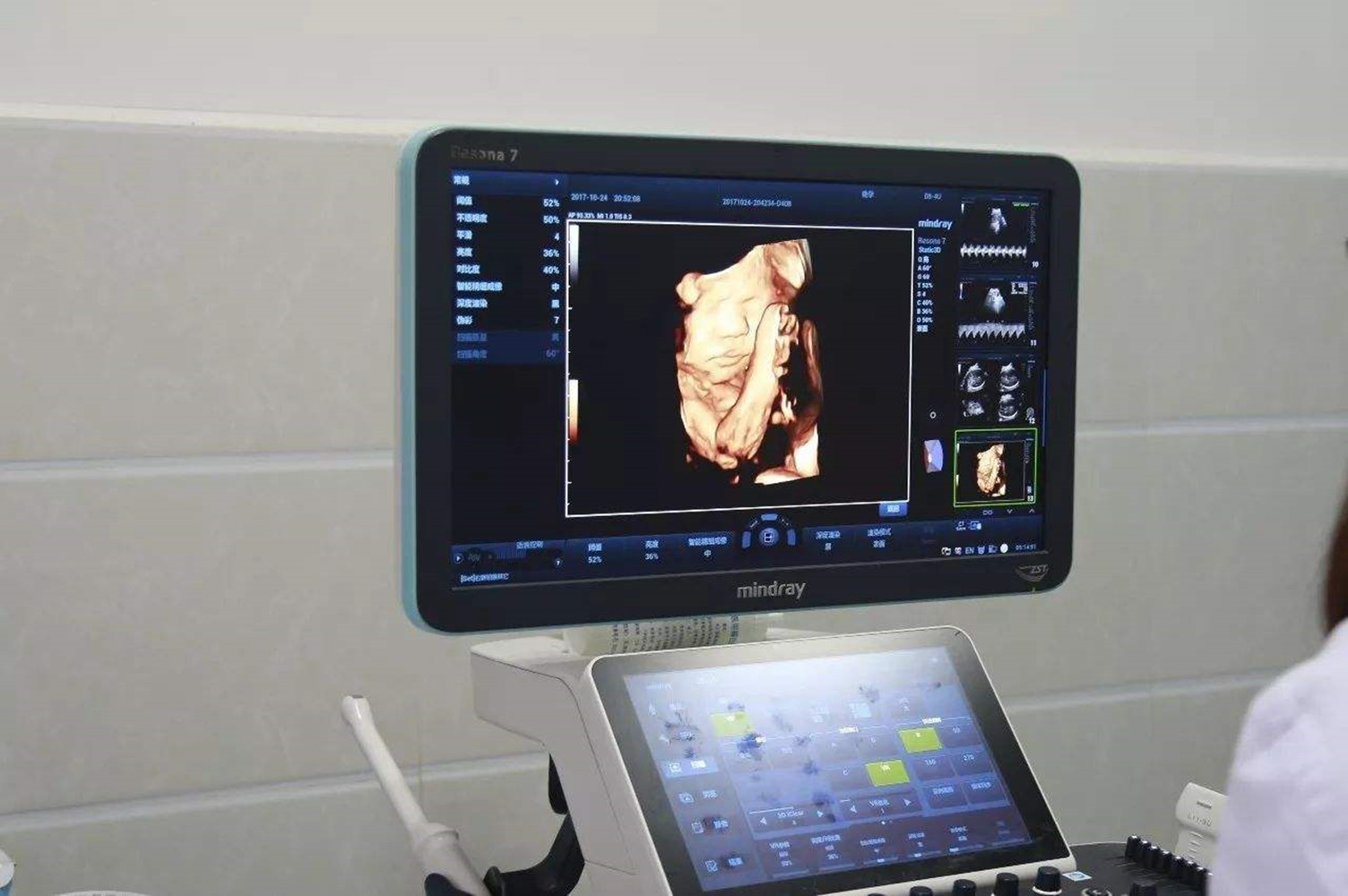 孕期看宝宝照片管用吗,孕期四维彩超看五官