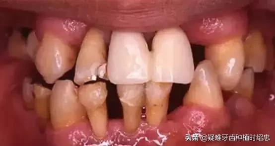 如何预防和治疗牙周炎,矫正完怎么预防牙周炎