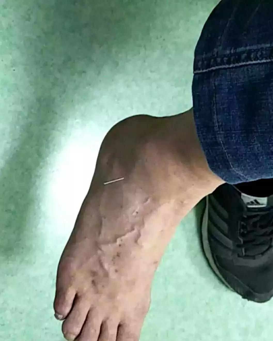 人体有“极联”，交经缪刺，左右互治——肢体关节痛一针效果显