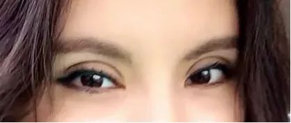 两眼间距宽割双眼皮,双眼皮割宽了还可以做修复吗