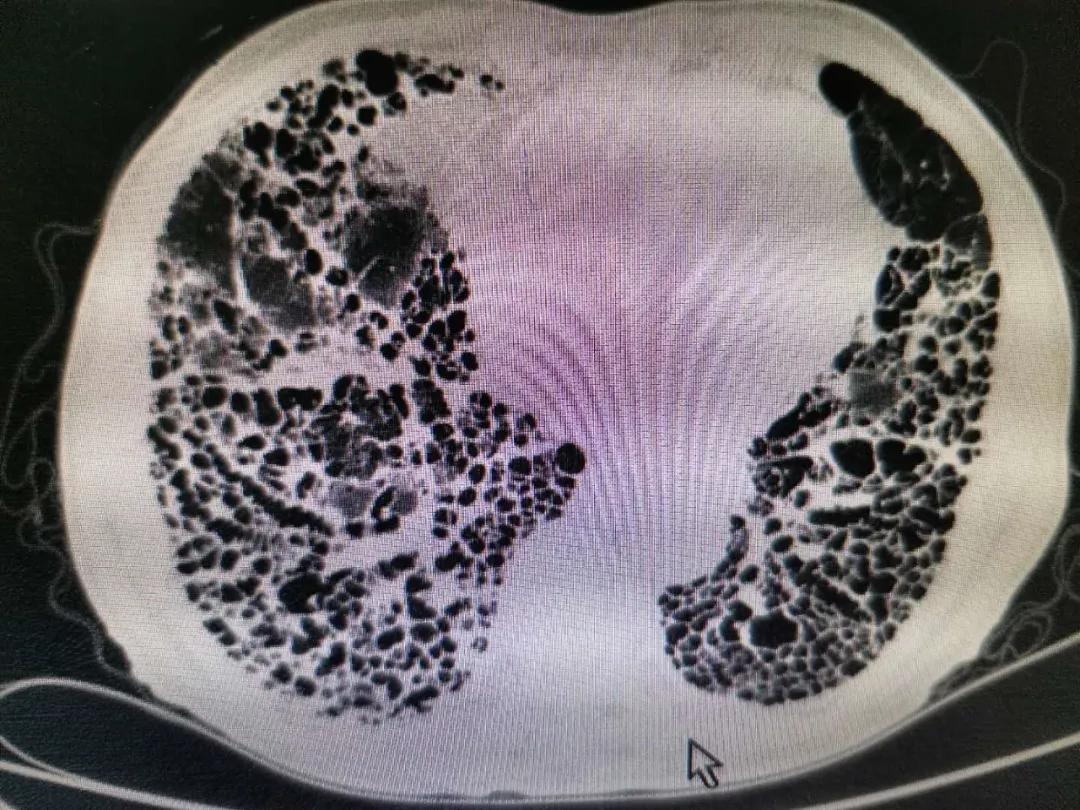 辽阳三院成功救治特发性肺间质纤维化急性加重高龄患者