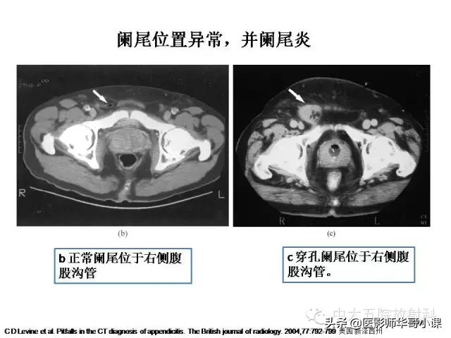 阑尾炎课件,阑尾炎的超声课件