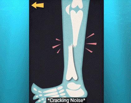 「医生告诉你」初三学子一开学就骨折！刚返校切勿“报复性运动”