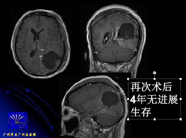 中医认为胶质瘤怎么来的,医学上什么叫胶质瘤