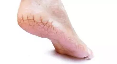 脚后跟干裂粗糙是脾胃不和吗,脚后跟干裂皮肤缺水