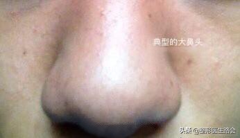 为什么长胖了鼻头也变大,鼻头大瘦下来会不会跟着变小