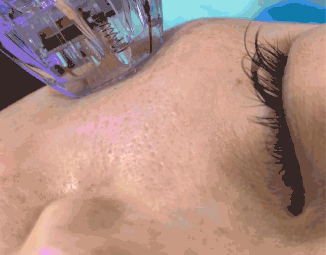 黑头粉刺毛孔粗大怎么隐形毛孔,毛孔粗大cc霜怎么用才能隐形毛孔