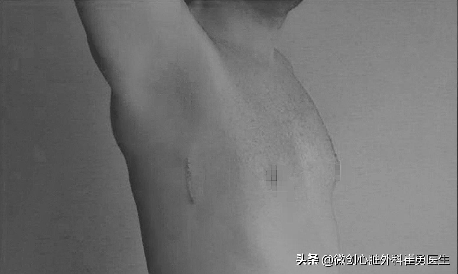 浙江省人民医院做心脏手术如何,浙江人民医院微创心脏手术