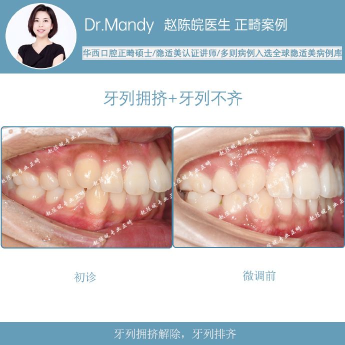 隐适美隐形矫正成功案例,经典隐形矫正