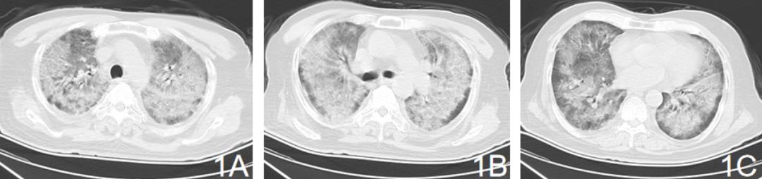 新冠症状容易与常见疾病症状混淆,症状和新冠一样怎么办