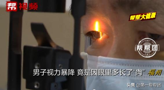 常在海边的注意了！男子视力严重下降，一查竟是眼中长了“肉”