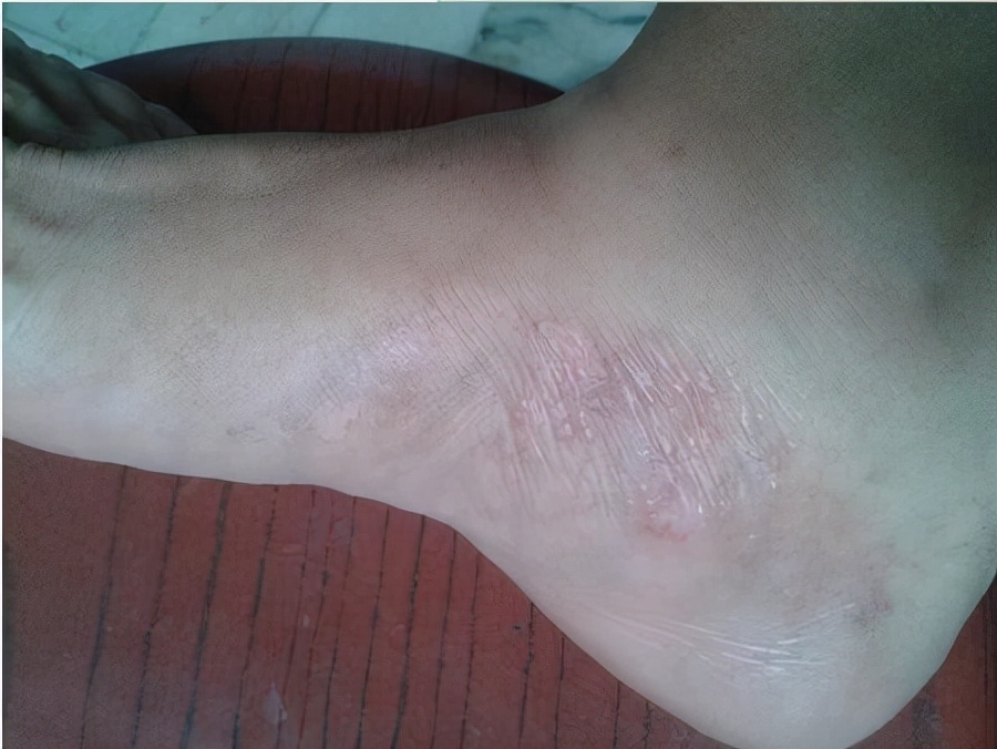 脚趾缝里面长个黄色水泡超级痒,脚趾缝长水泡脚趾缝糜烂奇痒无比