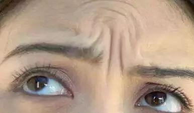 硬刚女皇龙妈也扛不住法令纹,2条沟壑让人心疼,贴一贴就消了