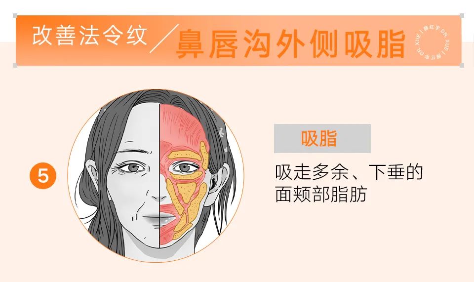 法令纹怎么改善脸部衰老,改善法令纹按摩手法视频