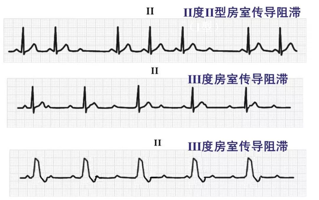 心律失常55分钟讲解,心律失常心电图讲解视频教程全集