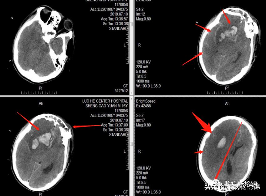 意外伤害很严重年纪轻轻难保命，谭院刀刀用真情豫南名医中中中