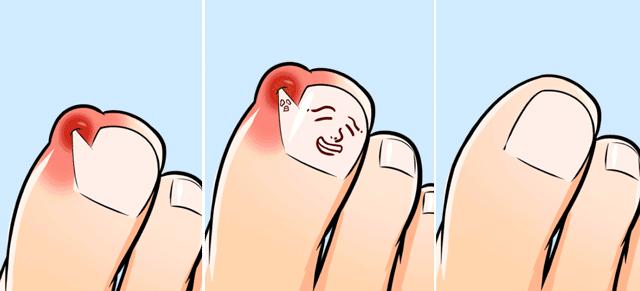 改掉啃手的习惯,拔肉刺引起甲沟炎