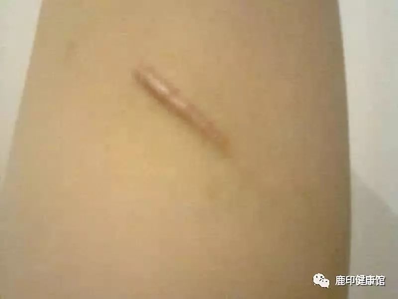 一不留神就崴脚，过几天脚不疼就是好了吗？