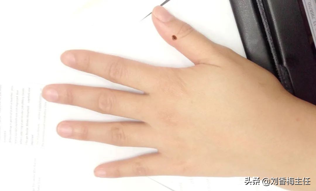 黑痣要弄掉看什么科,黑痣去除是看外科还是皮肤科