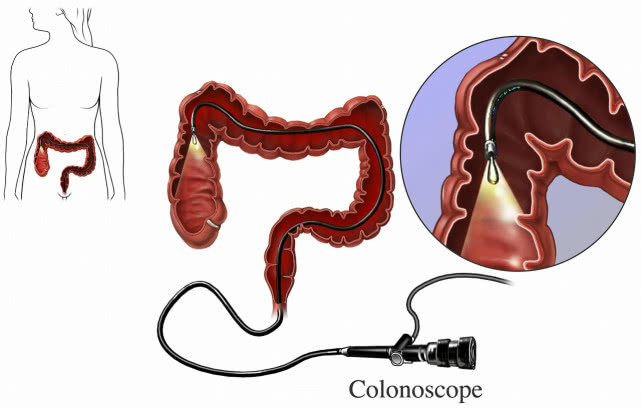 发现肠息肉就必须马上切除吗,得了肠息肉就一定要切除吗