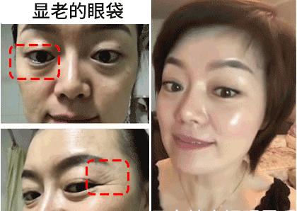 眼袋越来越严重怎么救,有眼袋显老十岁一招教你消除