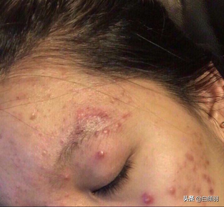 你们脸上两边的斑都是怎么去掉的,你们脸上痘印怎么去掉的