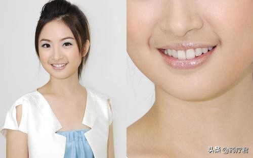 女性嘴唇长胡子怎么彻底去除,女生嘴唇为何长胡子