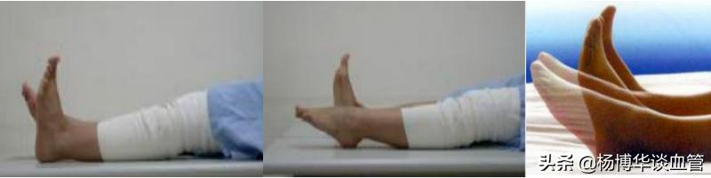 静脉血栓不必要制动怎么理解,静脉血栓用不用去滤网