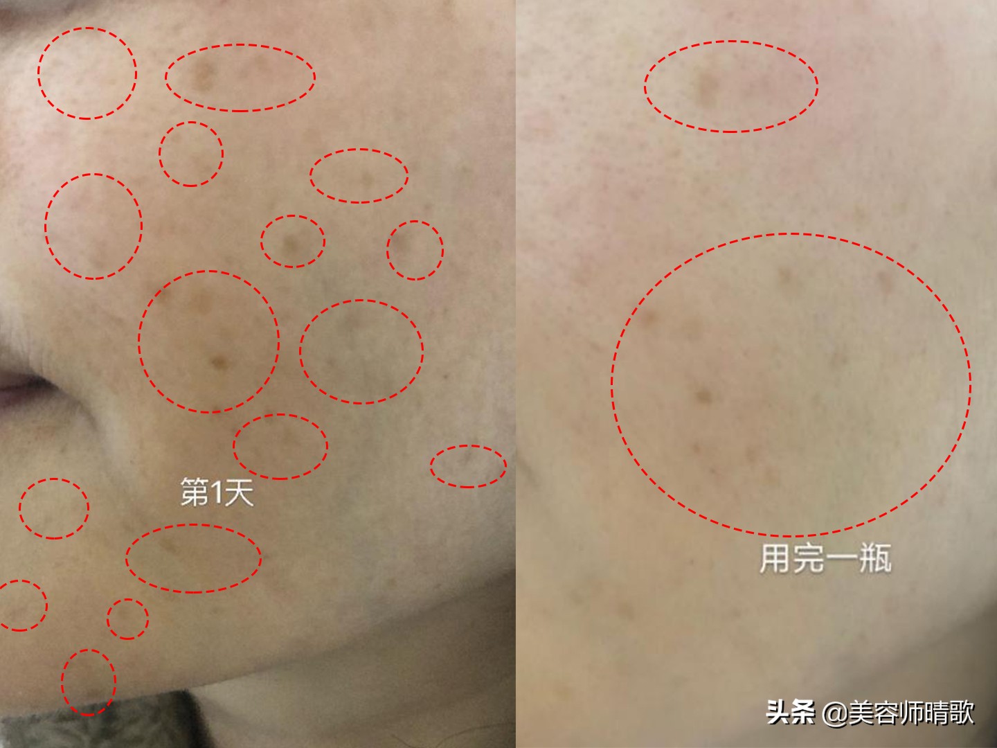 小白瓶淡斑精华推荐,淡斑小白瓶精华